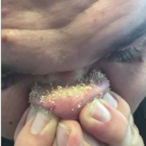 5pc Blackhead Whitehead Pimple Spot Comedone Acne Extractor Remover Popper Tool